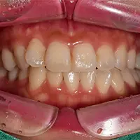 ホワイトニング BEFORE