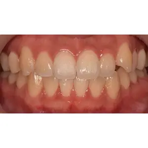 ホワイトニング BEFORE