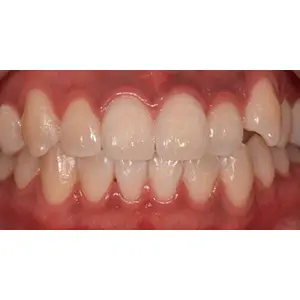 ホワイトニング AFTER