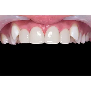 ラミネート AFTER