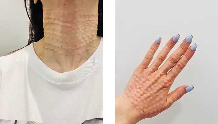 リジュラン注射