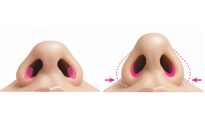 小鼻内側切開