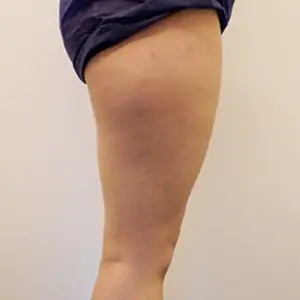 CAT注射（太もも） BEFORE