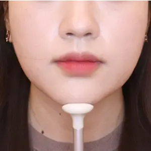 VCAT+頬骨CAT BEFORE