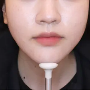 VCAT+頬骨CAT AFTER