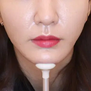 VCAT+頬骨CAT AFTER