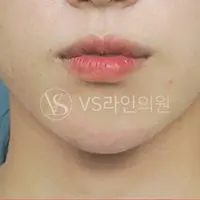 顎フィラー AFTER