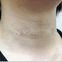 首のしわフィラー BEFORE