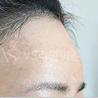 額フィラー BEFORE