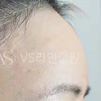 額フィラー AFTER