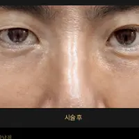 ジュベルック（目の下のくま・たるみ） AFTER