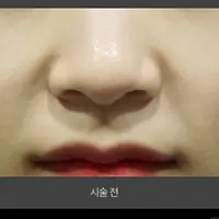 ジュベルック（ほうれい線） BEFORE