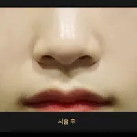 ジュベルック（ほうれい線） AFTER