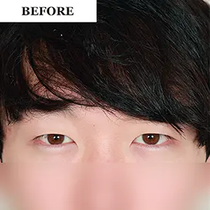 目の整形 BEFORE