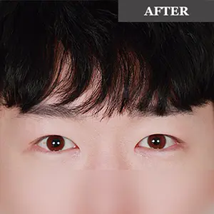 目の整形 AFTER