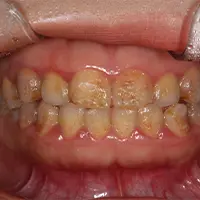 ラミネートべニア BEFORE