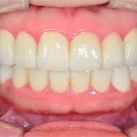 ラミネートべニア AFTER