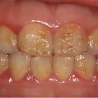 ラミネートべニア BEFORE