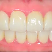 ラミネートべニア AFTER